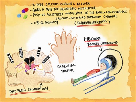 tremorgames alternative|Essential Tremor Treatment .